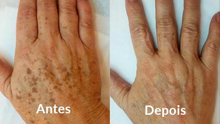 Antes e depois de manchas nas mãos após o tratamento