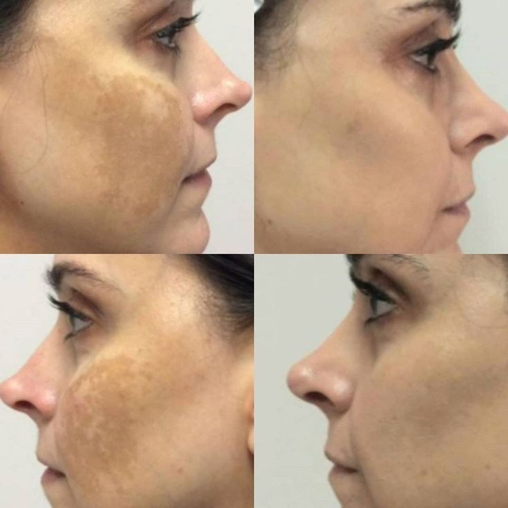 Antes e depois de melasma no rosto